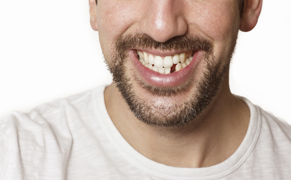 Zahnimplantate nach Zahnverlust